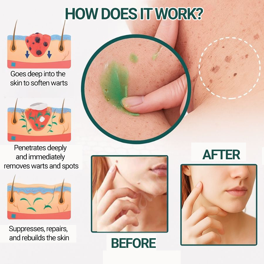 Luxevéria | Clinically proven to remove 97% of moles, warts, and skin imperfections — permanently in just 3 days!