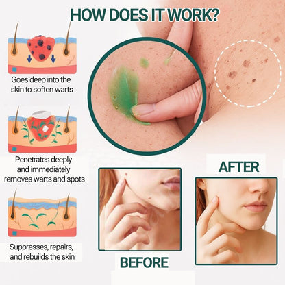 Luxevéria | Clinically proven to remove 97% of moles, warts, and skin imperfections — permanently in just 3 days!