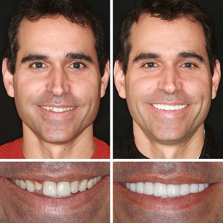 Ends Today: 58% OFF! ⏰58% OFF! EETTSY™ Medical Full Denture with Strong Suctiond Custom-Fit Full Functional Dentures🦷Obtain American Dental Association (ADA) Certification