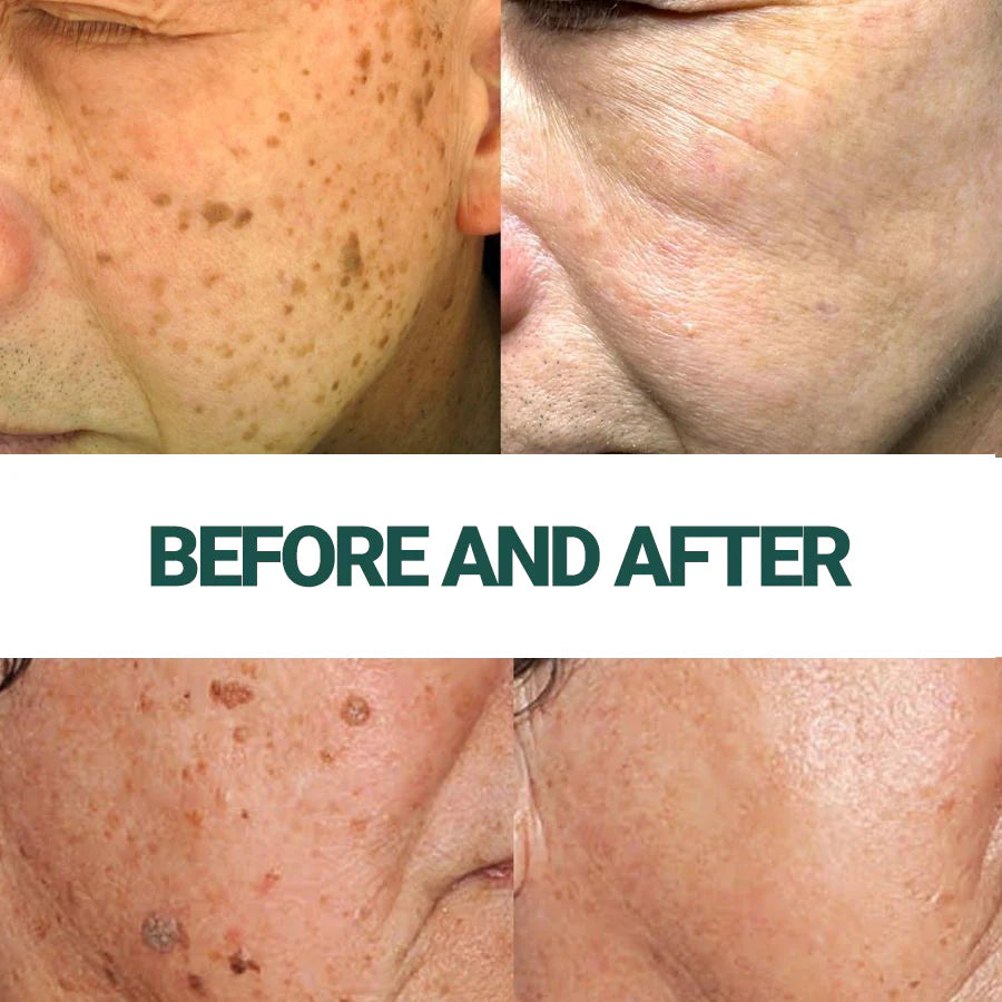 Luxevéria | Clinically proven to remove 97% of moles, warts, and skin imperfections — permanently in just 3 days!