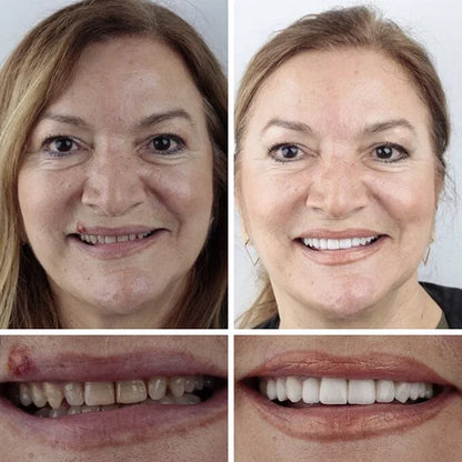 Ends Today: 58% OFF! ⏰58% OFF! EETTSY™ Medical Full Denture with Strong Suctiond Custom-Fit Full Functional Dentures🦷Obtain American Dental Association (ADA) Certification