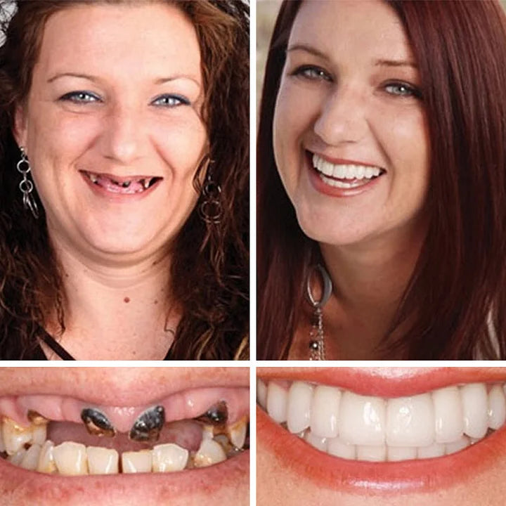 Ends Today: 58% OFF! ⏰58% OFF! EETTSY™ Medical Full Denture with Strong Suctiond Custom-Fit Full Functional Dentures🦷Obtain American Dental Association (ADA) Certification
