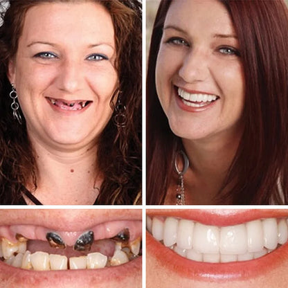 Ends Today: 58% OFF! ⏰58% OFF! EETTSY™ Medical Full Denture with Strong Suctiond Custom-Fit Full Functional Dentures🦷Obtain American Dental Association (ADA) Certification