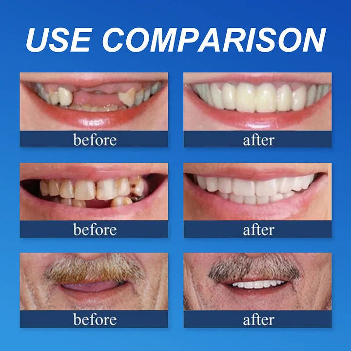 Ends Today: 58% OFF! ⏰58% OFF! EETTSY™ Medical Full Denture with Strong Suctiond Custom-Fit Full Functional Dentures🦷Obtain American Dental Association (ADA) Certification